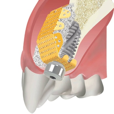 Special flat membrane mesh, combined