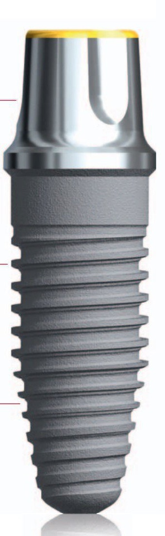 Nobel Direct Posterior main image