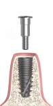 Cover screw