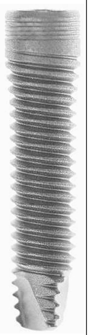 Tidal Screw Implant System TSS main image