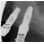 FIXUM Dental Implants Fixum image 12