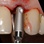 Intra-Lock System International External Hex Conic image 1