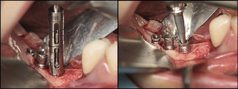 dental-implant-removal.png