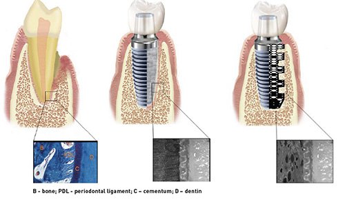 smart dental implant2.jpg