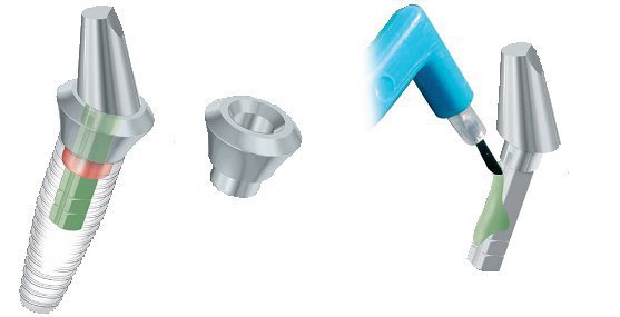 Bone System Bone SystemLN Dental Implant | SpotImplant
